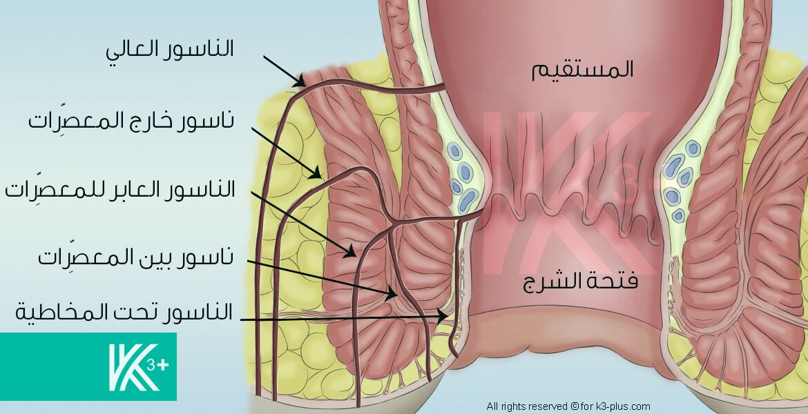 افضل علاج للناسور: دليل شامل واحترافي